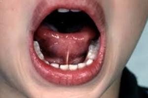 Dr. David - Bolton, MA Dentist - Frenulum