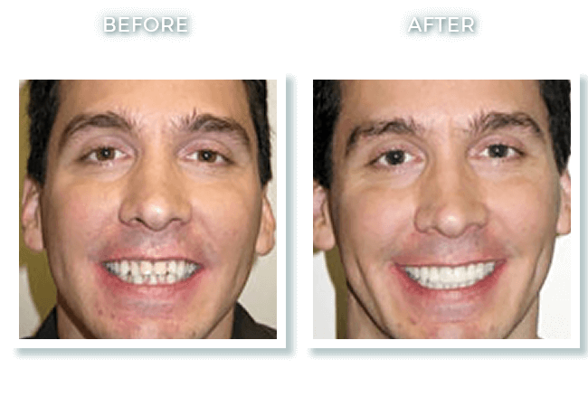 Bolton MA Dentist Dr. David Invisalign Teeth Crowding Correction