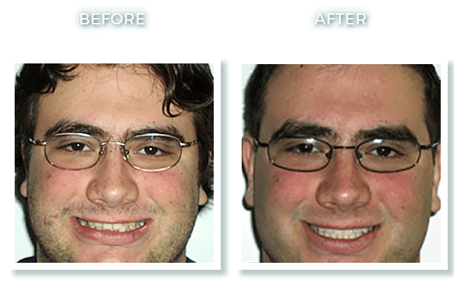 Bolton MA Dentist Dr. David Invisalign Upper Teeth Overlap