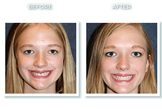 Bolton MA Dentist Dr. David Invisalign Front Teeth Spacing Correction