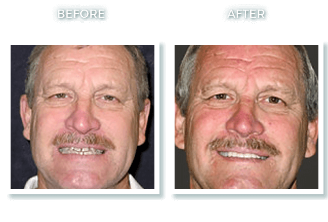 Bolton MA Dentist Dr. David Invisalign Moderate Spacing Correction