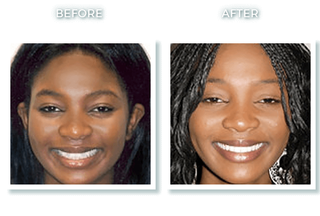 Bolton MA Dr. David Invisalign Anterior Crossbite Correction