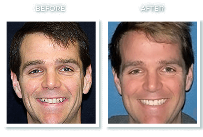 Bolton MA Dentist Dr. David Invisalign Overbite Correction