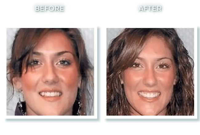 Bolton MA Dentist Dr. David Invisalign Mild Crowding Correction