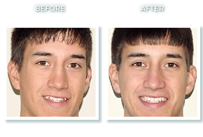 Bolton MA Dentist Dr. David Invisalign Moderate Crowding Correction