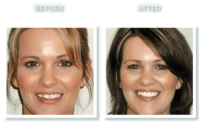 Bolton MA Dentist Dr. David Invisalign Overbite & Crowding Correction