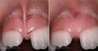 Dr. David - Bolton, MA Dentist - Frenectomy