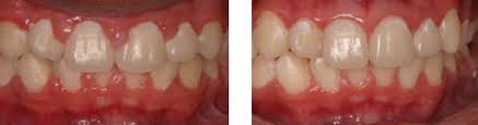 Dr. David - Bolton, MA Dentist - Gingivectomy