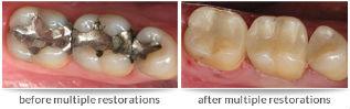 Dr. David - Bolton, MA Dentist - Multiple Teeth Restorations Before After