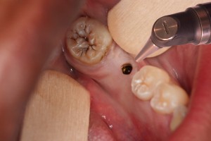 Dr. David - Bolton. MA Dentist - Peri-implantitis Treatment