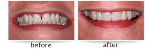 Dr. David - Bolton, MA Dentist - Veneers, Before and After