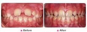 Bolton, MA Dentistry by Dr. David Myobrace Teeth Straightening Before-After