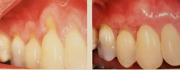 Gum recession can happen even in a healthy mouth