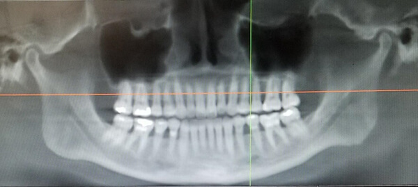 Bolton, MA Dentist Dr. David - ICat FLEX Teeth X-Ray