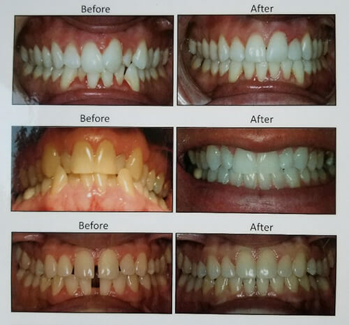 How Long Does Invisalign Take to Straighten Teeth?