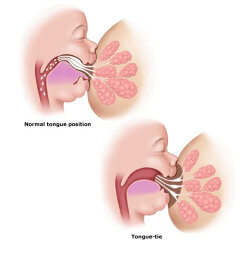 Tongue tie store baby bottle feeding