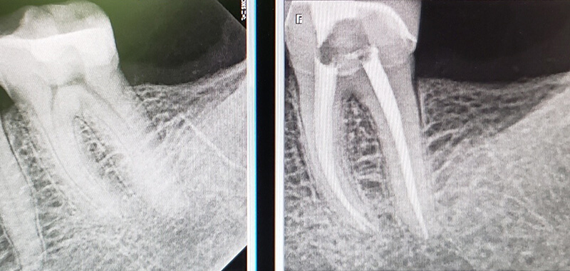 Root canal treatment done with ozone therapy