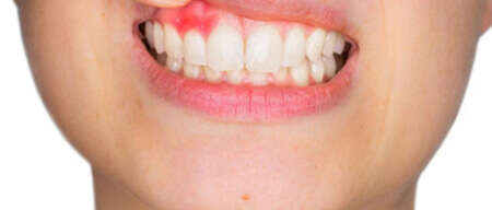 What to know about gum disease