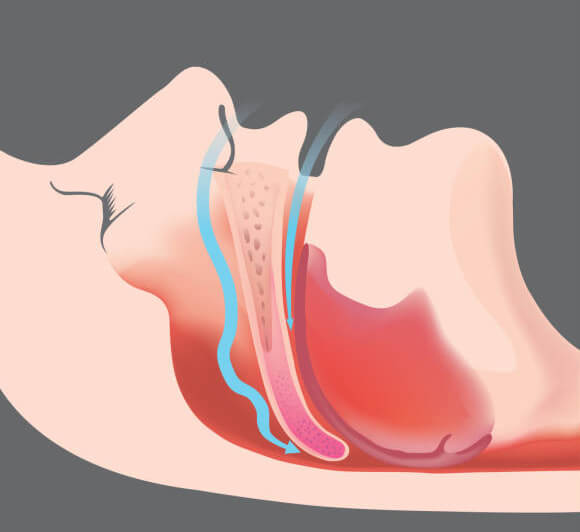 CPAP Machine versus Oral appliance: Which one is better?