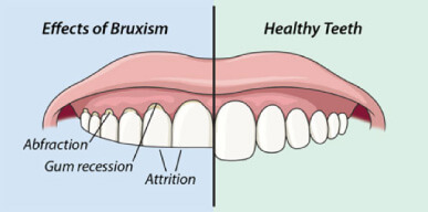 Bruxism