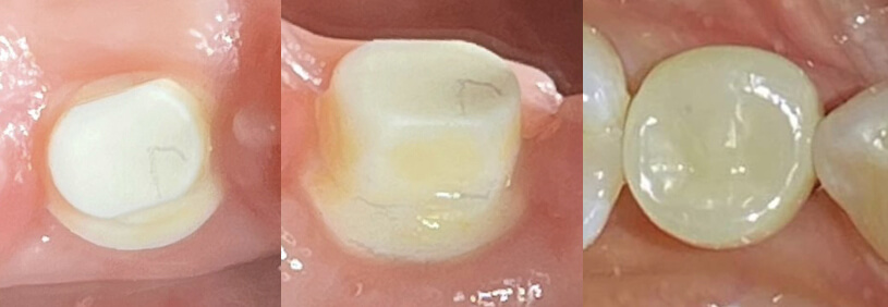 Zirconium Implants