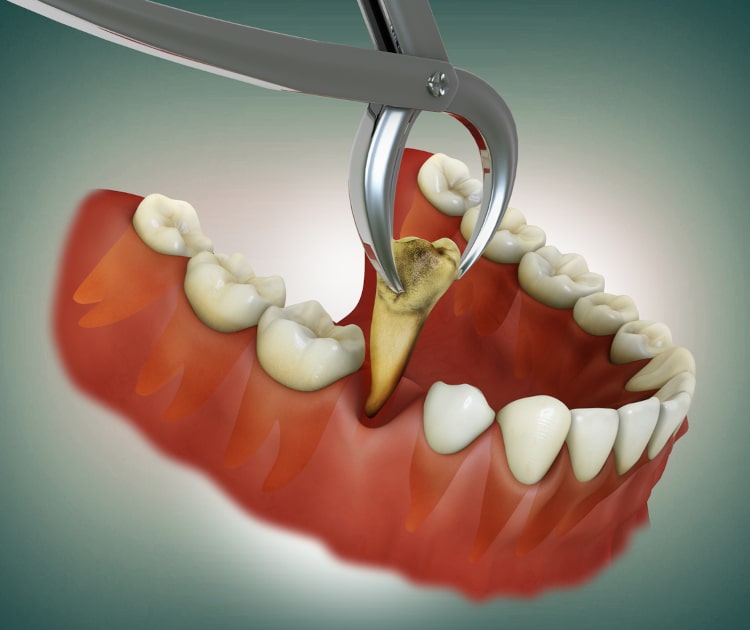 Common Questions about Tooth Extractions in Massachusetts